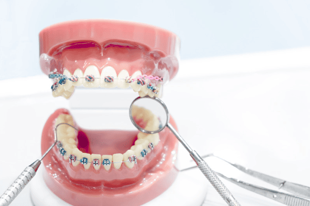 Braces (Orthodontics) 箍牙 牙齒矯正