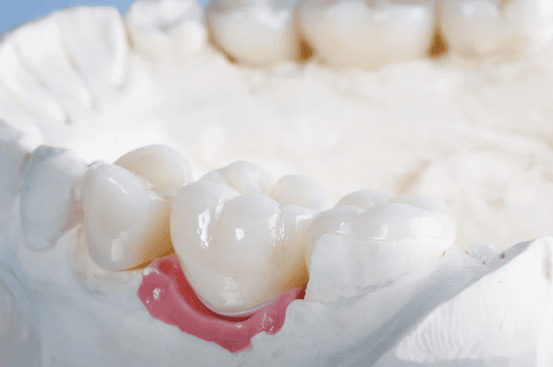 Dental Crowns & Bridges 牙冠(牙套)和牙橋