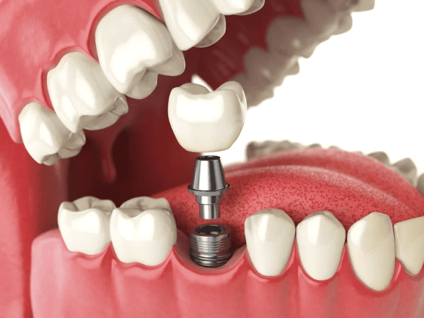 Dental Implants 植牙 種牙