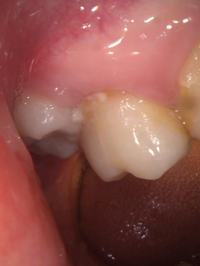 Infected or Inflamed Tooth Pulp 牙髓神經感染發炎