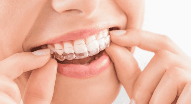 Invisalign Invisible Braces 隱適美 隱形牙箍