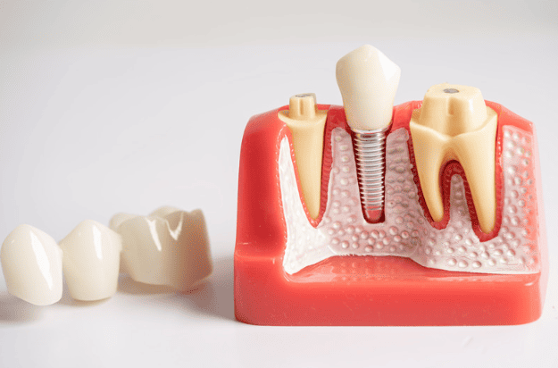 Risks of Root Canal Treatment 杜牙根治療有甚麼風險？