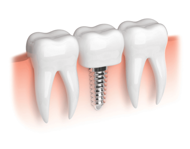 Dental implants Guide 種牙過程 種牙價錢 種牙後遺症