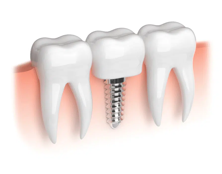Dental implants Guide 種牙過程 種牙價錢 種牙後遺症