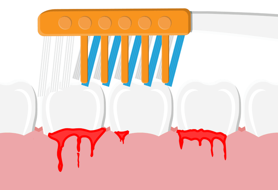 Gum Disease Treatment 牙周病治療