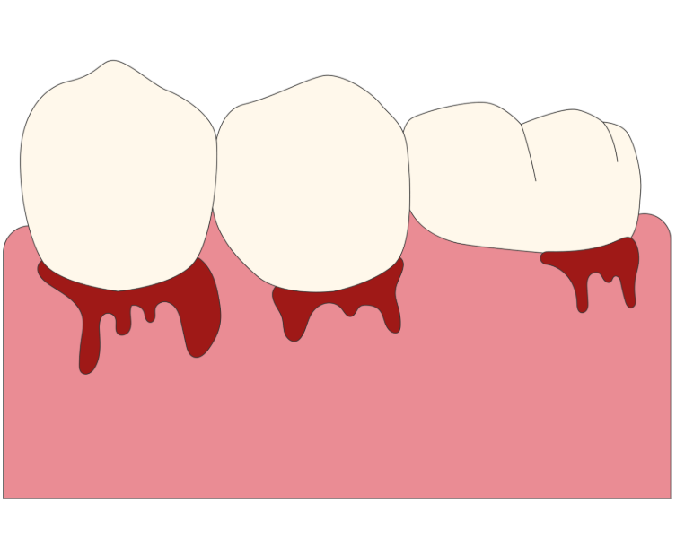 Gum Disease Treatment 牙周病治療