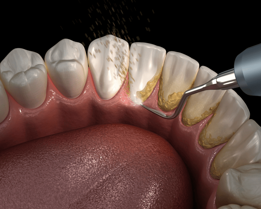 gum disease deep cleaning 牙周病深層清潔