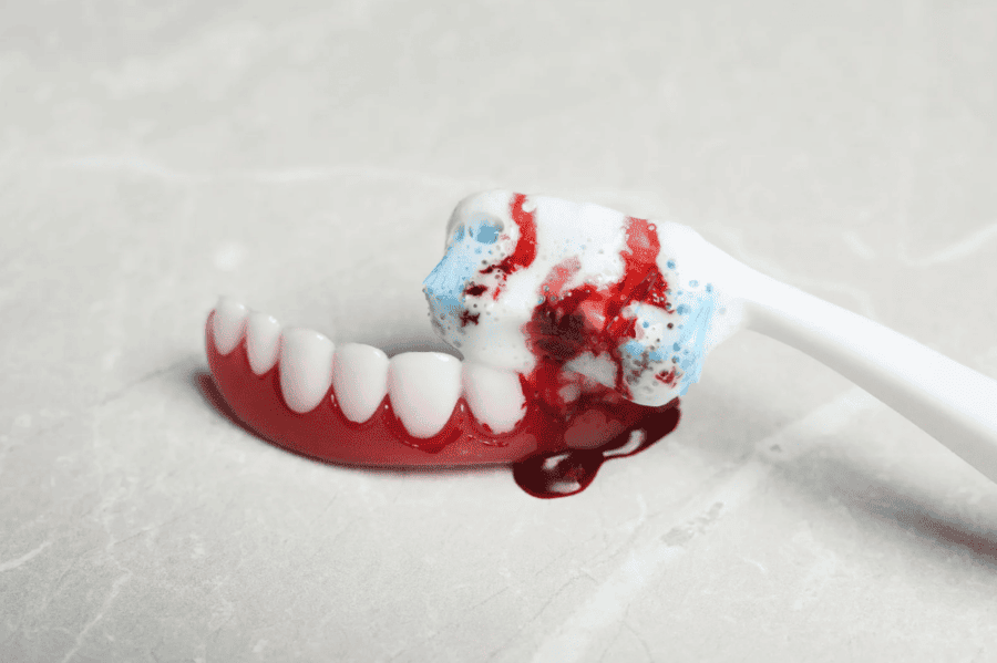 gum disease post treatment care 牙周病治療後護理