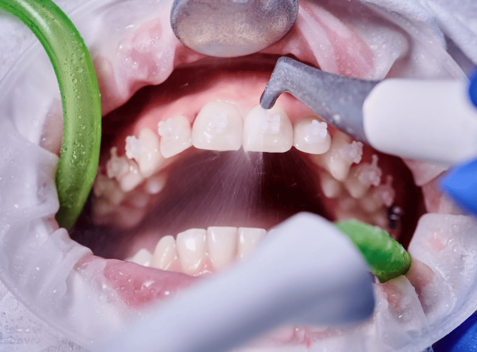 teeth cleaning process 洗牙過程