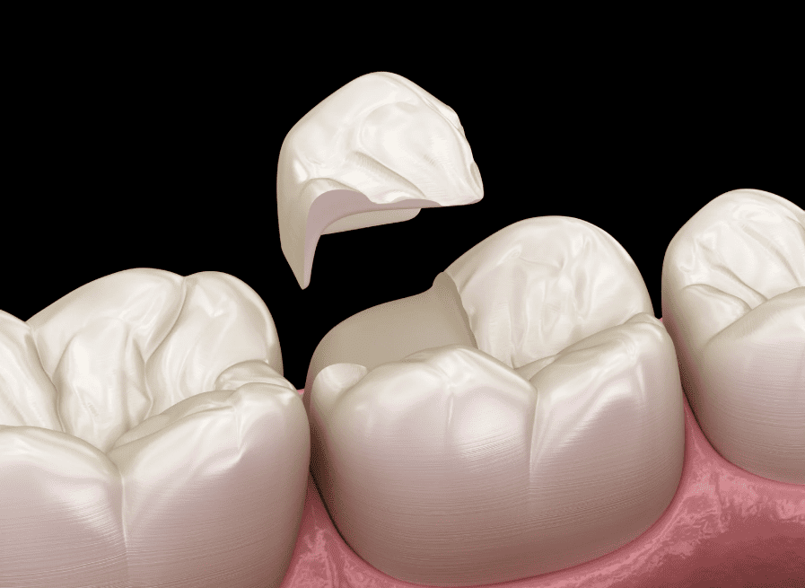 Tooth Fillings 補牙